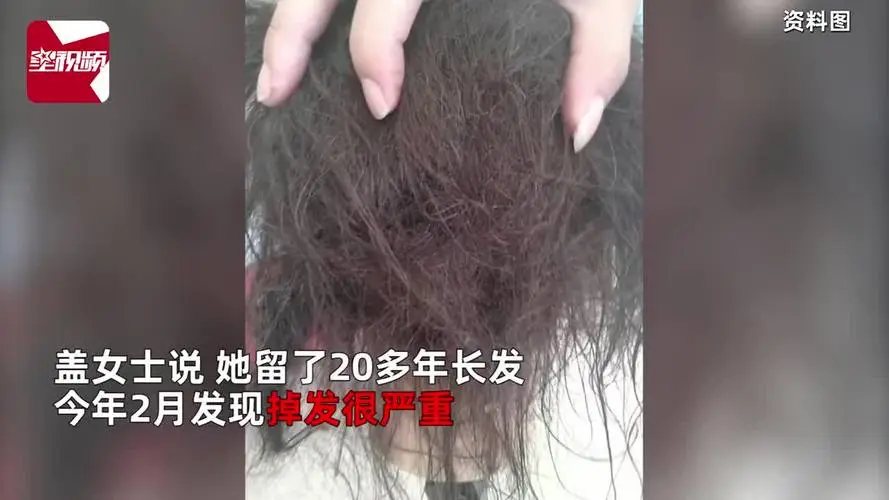 广东一女子怕头秃3个月不洗头，惊喜长出碎发后，结果却悲剧了
